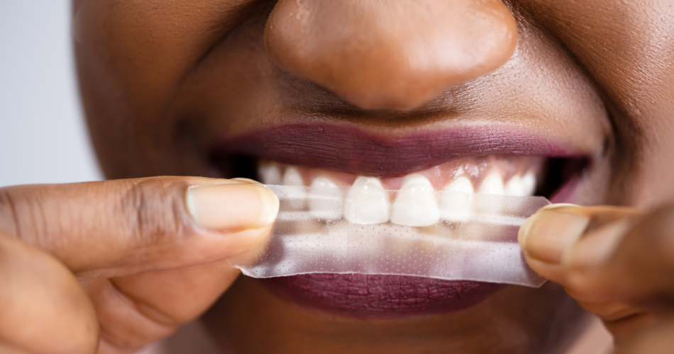 How Long Does Teeth Whitening Last and How to Prolong It Effectively?